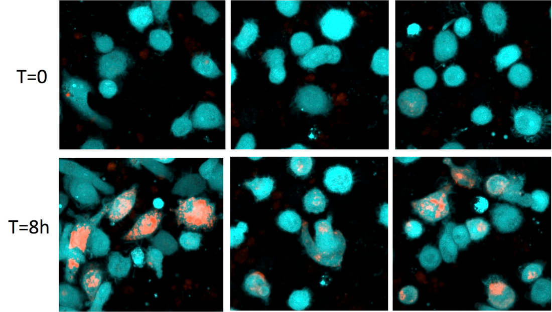 Myelin Phagocytosis - Imaging